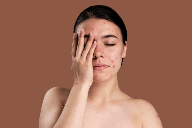 10 วิธีรักษาสิวผดเร่งด่วน บอกลาปัญหาผดขึ้นหน้าผาก