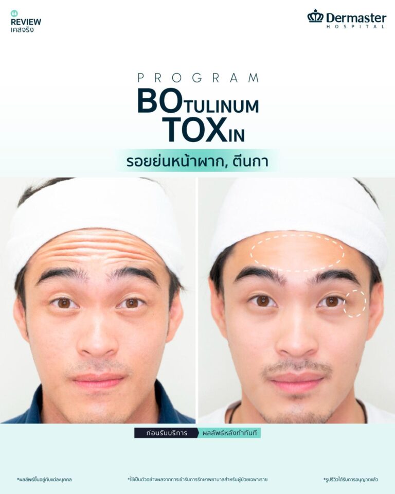 โบท็อก (Botox) ตัวช่วยลดริ้วรอยบนใบหน้า รู้ครบก่อนตัดสินใจฉีด